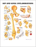 股関節と膝の炎症